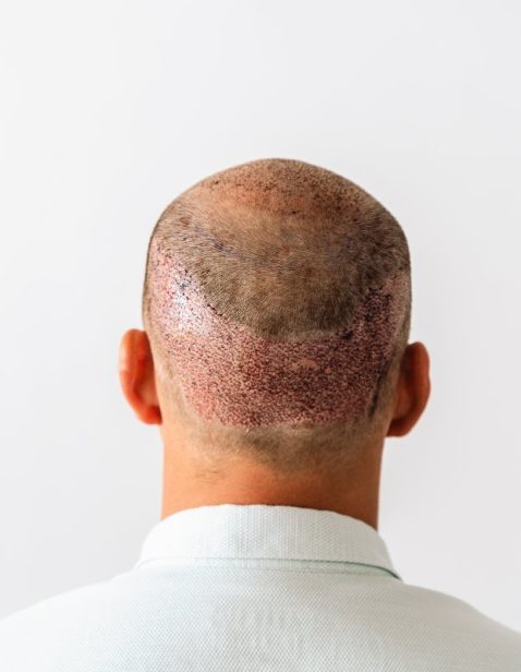 after-hair-transplantation-surgical-technique-that-2022-10-05-22-47-21-utc