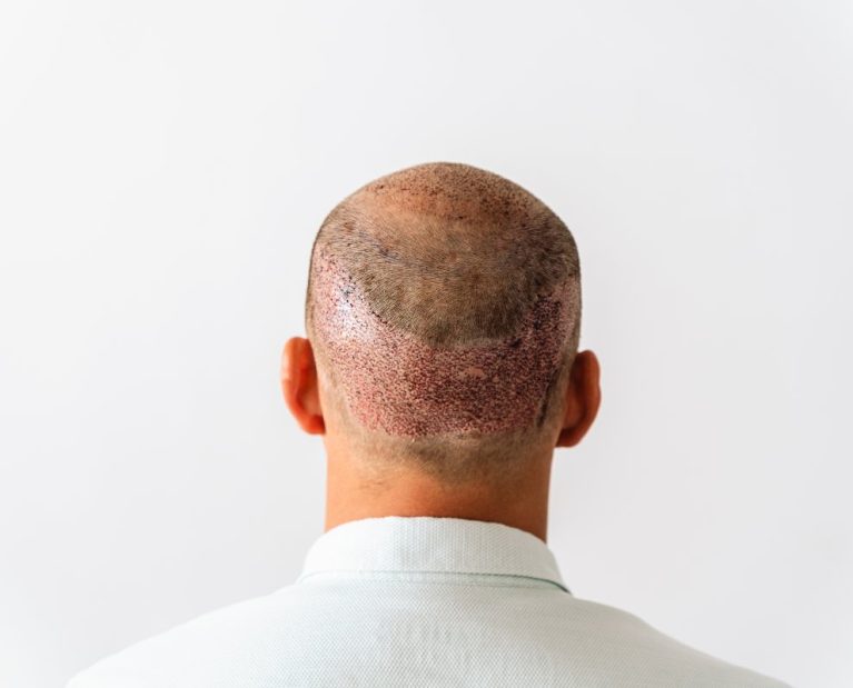 after-hair-transplantation-surgical-technique-that-2022-10-05-22-47-21-utc