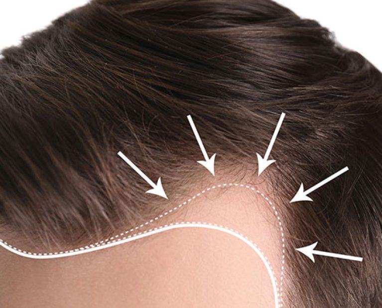 افضل-مركز-زراعة-الشعر-في-اسطنبول